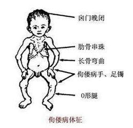 成人佝偻病走路视频大全,视频大全深度解读