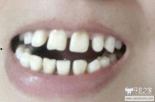 成人牙齿稀疏图解视频,揭秘原因与改善方法
